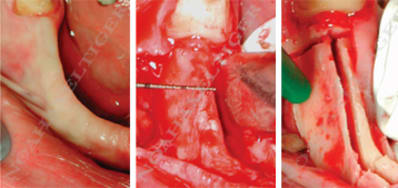 Splitting mandibulaire nnrckm - Eugenol