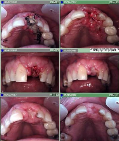 Suite lambeau tlmdh1 - Eugenol