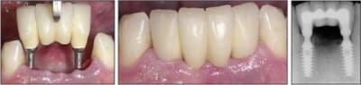 Surgical 4s zkt8un - Eugenol