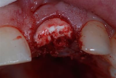 Suture membrane repaqk - Eugenol