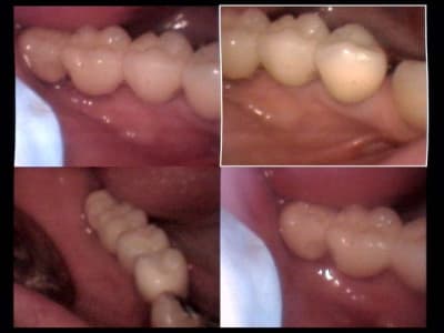 Un cas difficile bridge scellé sur piliers vissés sur implants 47 et 46 et 45 et 44   3 zwahr0 - Eugenol