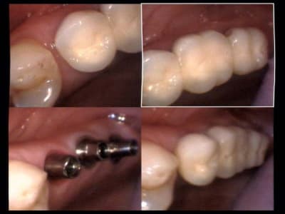 Un cas difficile essai bridge sur implants 25 et 26 et 27 evznvr - Eugenol