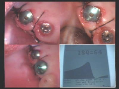 Un cas difficile réouverture implants 16 et 17 iv nag7o7 - Eugenol
