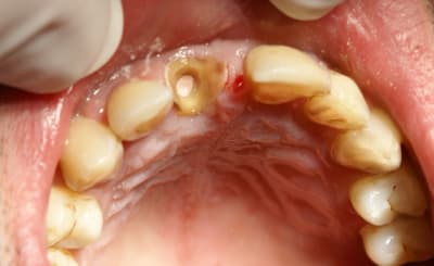 Une 11 apicectomis e depuis 6 mois 2 gewozi - Eugenol