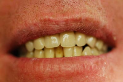 Vue anterieure bridge non arme as2fq6 - Eugenol