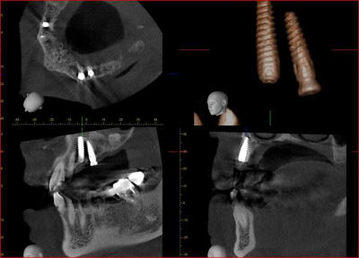 Vue implant vjiqt3 - Eugenol