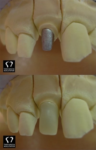 Zircone opaque ycpcnw - Eugenol
