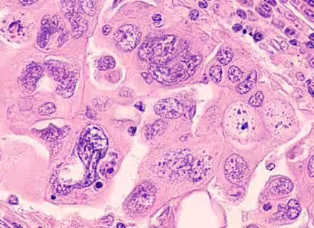 A microscopic image of a tissue sample stained with hematoxylin and eosin, showing clusters of irregularly shaped cells with prominent nuclei, some with visible nucleoli, and variable cytoplasm. The sample has a pink and purple color palette.
