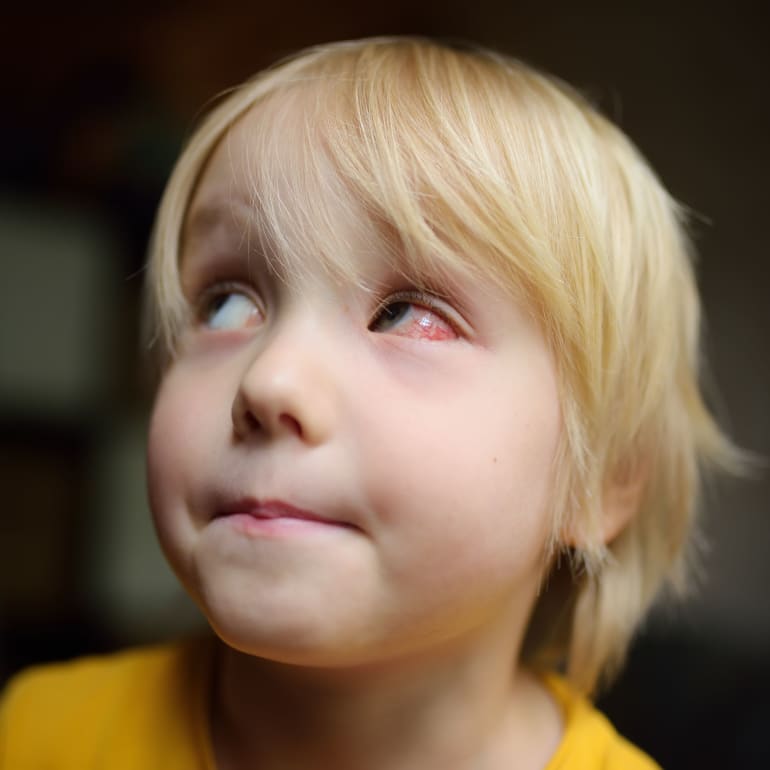 Rote Augen bei Kindern