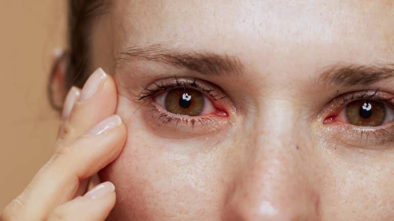 Eye inflammation