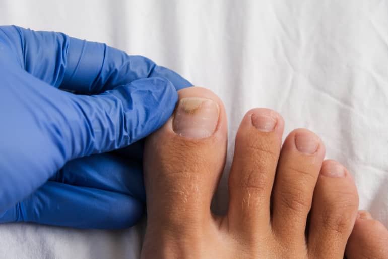 Tko je izložen povećanom riziku od gljivičnih infekcija noktiju?