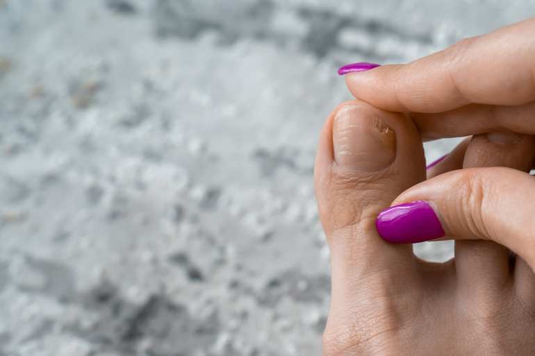 Zig-zag What are fungal infections