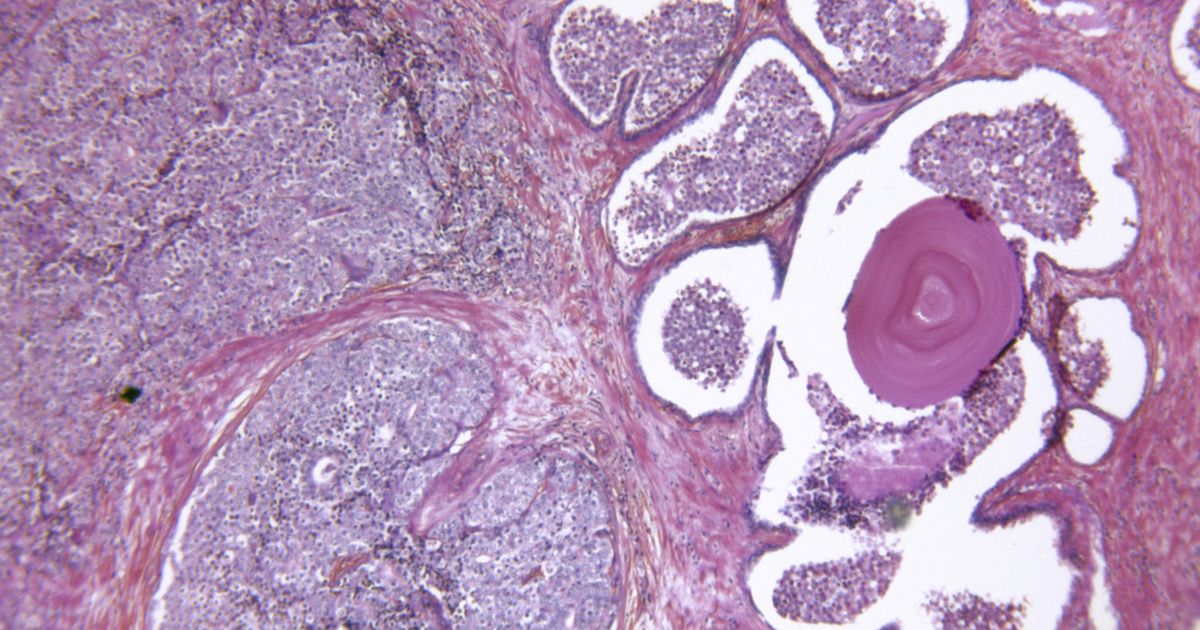 Is It Prostate Cancer or Something Else? - Sharecare