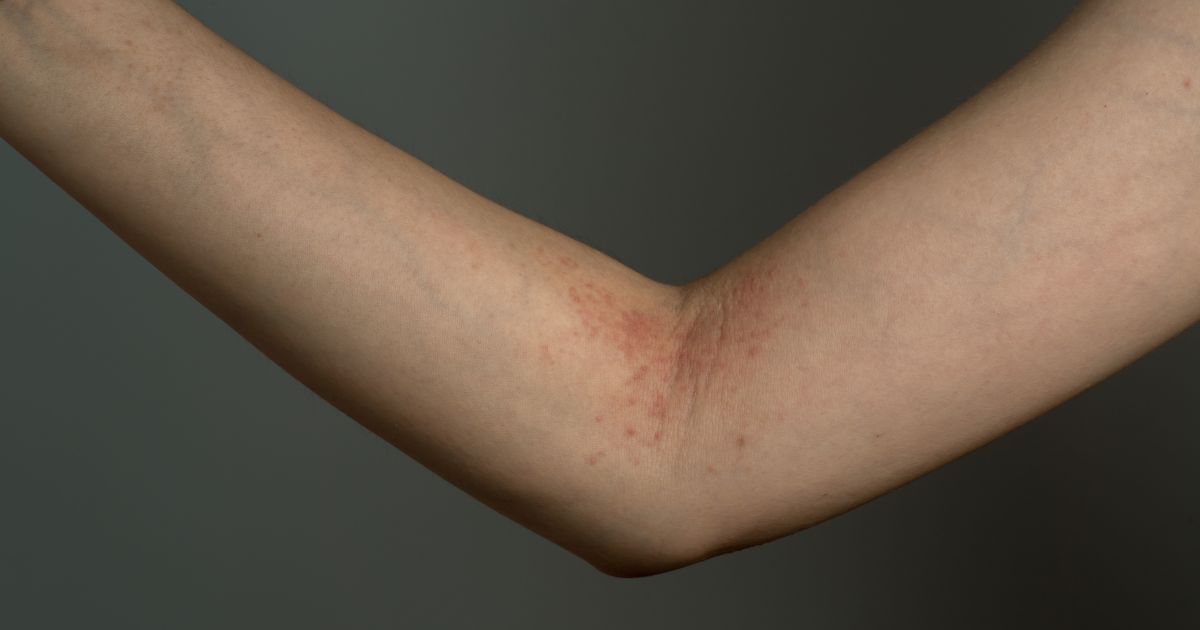 6 Things That Can Worsen Atopic Dermatitis Skin Disorders Sharecare Most people with atopic dermatitis have at least one of the fo.