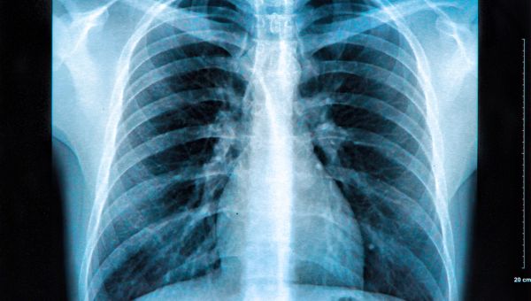 X-Ray image of the human chest