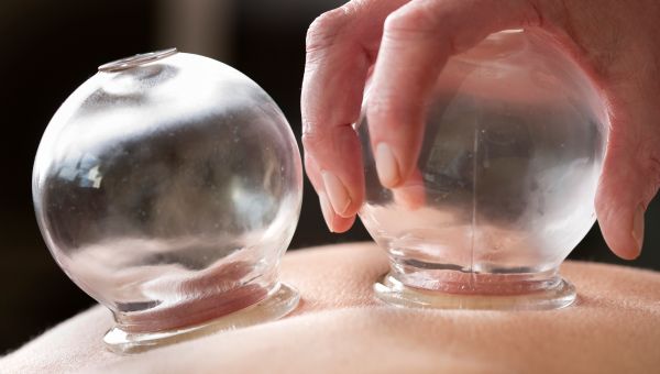 cupping