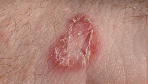 Infection of ringworm on a person with light skin