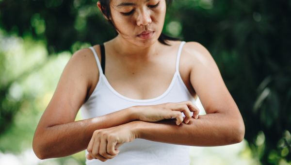 woman scratching a bug bite on her arm