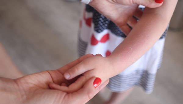 mother checks rash on child's arm 
