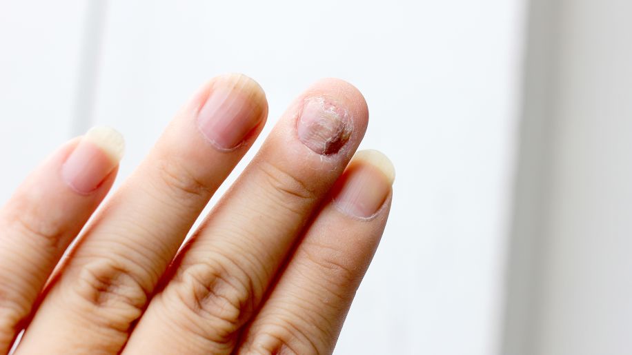 finger, broken finger nail, fungal infection