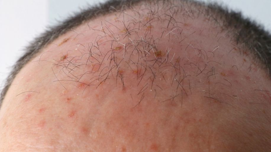 Small red lesions on a man's balding head.