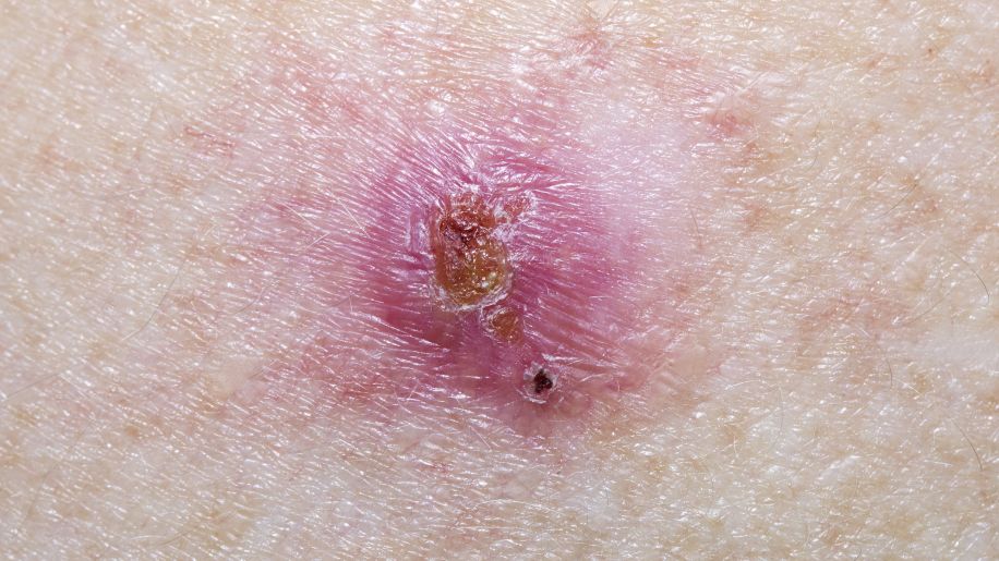 basal cell carcinoma