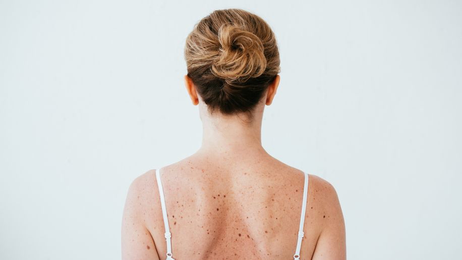 Freckles on woman's back.