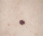 Surprising Spots to Check for Skin Cancer | Skin Cancers - Sharecare