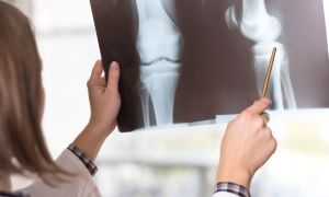 Rheumatoid Arthritis Tests and Exams