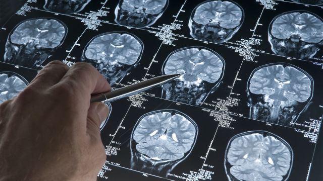 A doctor pointing out concussion evidence on an MRI brain scan.