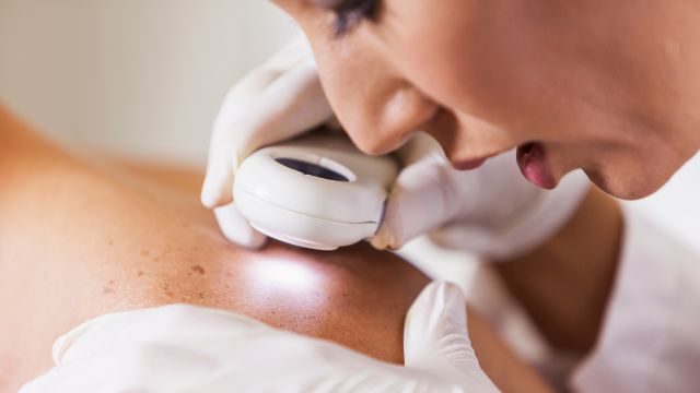 Doctor using a medical device to look for different types of skin cancer spots, moles or bumps on someone's back.