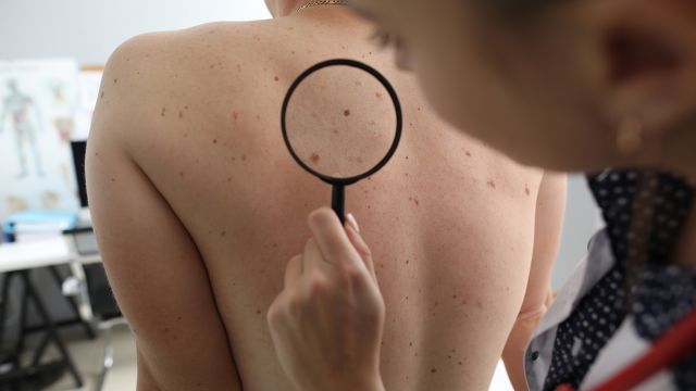 A dermatologist examines a patient for abnormal spots on the back of patient. 