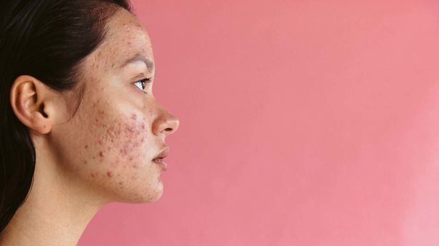 Acne is generally categorized as mild when pimples occur close to the surface of the skin. Acne is considered more severe when pimples occur deeper in the skin.
