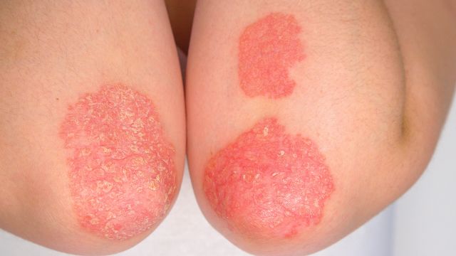 If your psoriasis treatment is not working, here are different approaches to treatment that you might discuss with your healthcare provider.