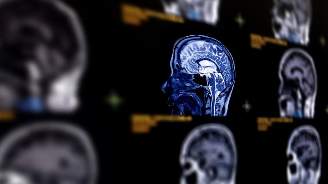 An MRI brain scan for detecting the aftereffects of an aneurysm.