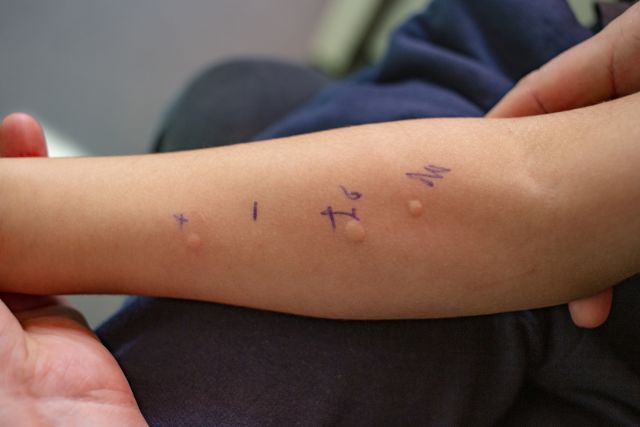 A child has a skin reaction to an allergen during a skin prick test. The skin prick test is one diagnostic test healthcare providers may use to diagnose food allergies.