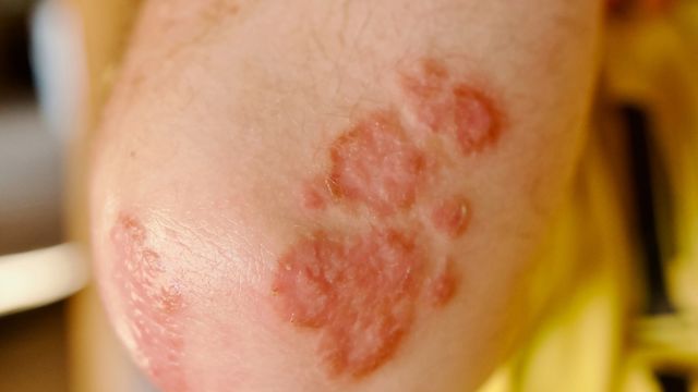 Close up of psoriasis on an elbow, one of the most common sites for psoriasis symptoms to occur.