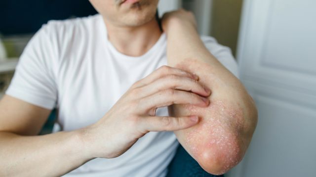 A young man examines a psoriasis plaque on his elbow.