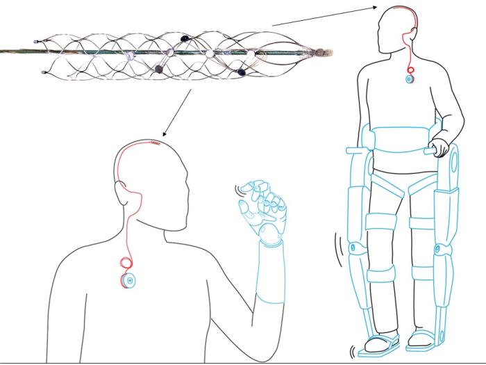 The stentrode can record brain signals from within a blood vessel next to the brain. These thoughts are captured, decoded and passed wirelessly through the skin to enable control of an exoskeleton.